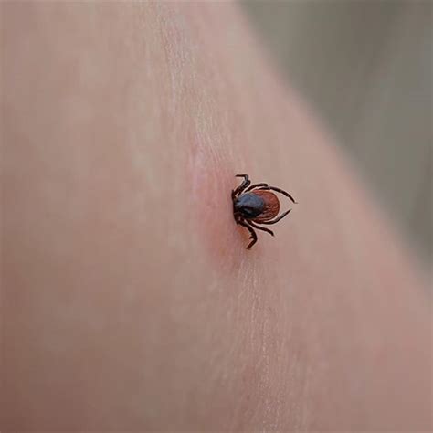 How To Remove A Tick