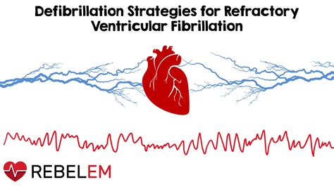 Rebel Cast Ep113 Defibrillation Strategies For Refractory Ventricular