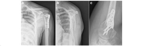 Postoperative Radiographs At Three Months Post Surgery Showing Osseous