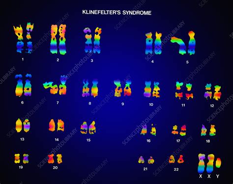 klinefelter s syndrome karyotype stock image c022 0585 science photo library