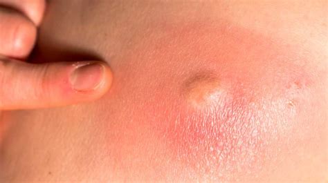 Raised Skin Bump 25 Causes Photos And Treatments Su Oggi
