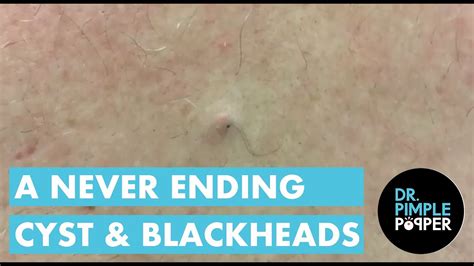 A Never Ending Cyst And Blackheads Youtube