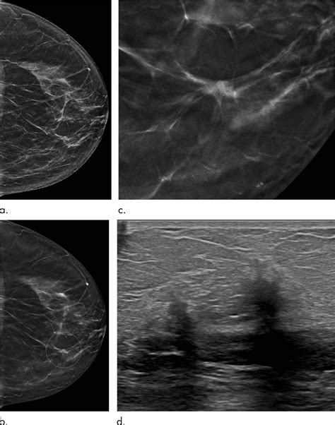 Tomosynthesis Outperforms Digital Mammography Eurekalert