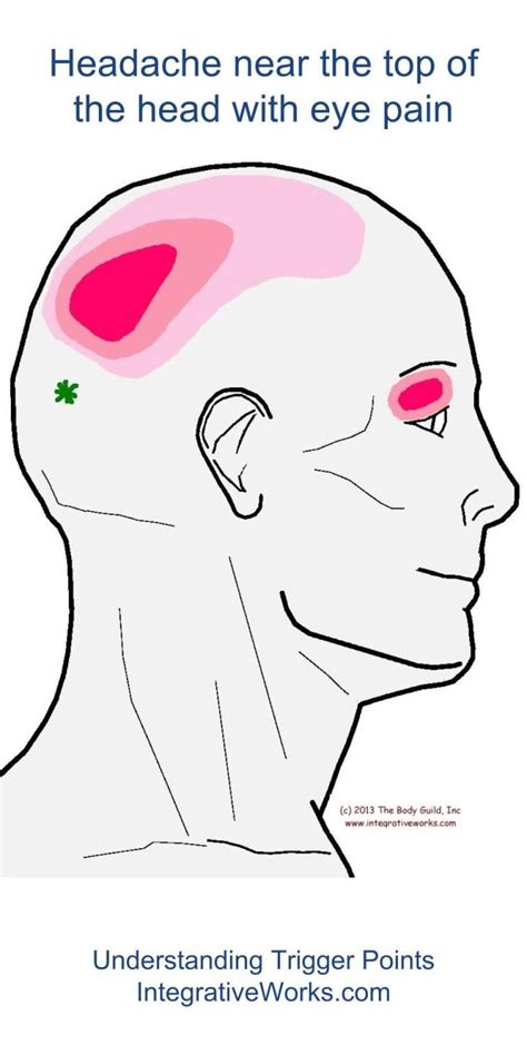 Headache Integrative Works Eye Pain Trigger Points Headache