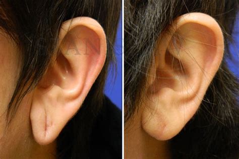 Earlobe Repair Gallery 1 Before And After Photos Connecticut