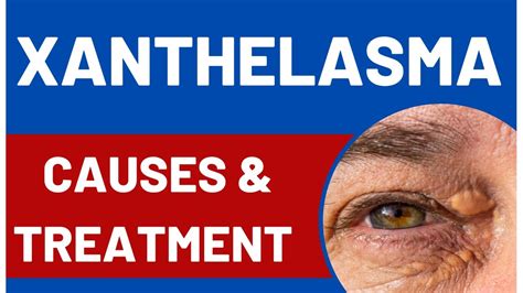 Xanthelasma Meaning Causes And Treatment Youtube