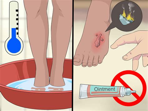 But since sun happens, here's how to treat a sunburn if you get one. 3 Ways to Treat a Serious Burn - wikiHow