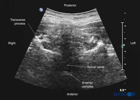 Spinal Sonography And Applications Of Ultrasound For Central Neuraxial