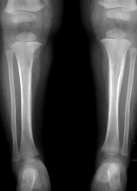 Metaphyseal Lesions And Periosteal Reaction Of Long Bones In A Child