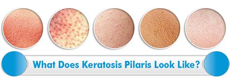 The Most Effective Keratosis Pilaris Treatment Life Support