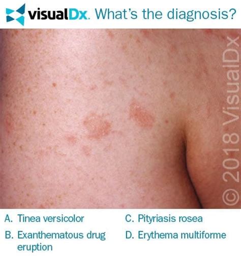 Man Notices Spreading Non Itching Rash Lets Diagnose Visualdx
