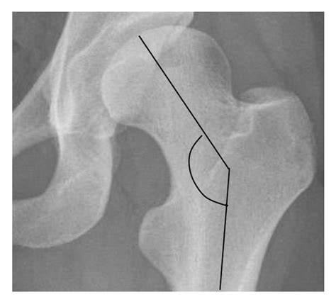 A Acetabular Depth Ratio B Center Edge Angle Of Wiberg C