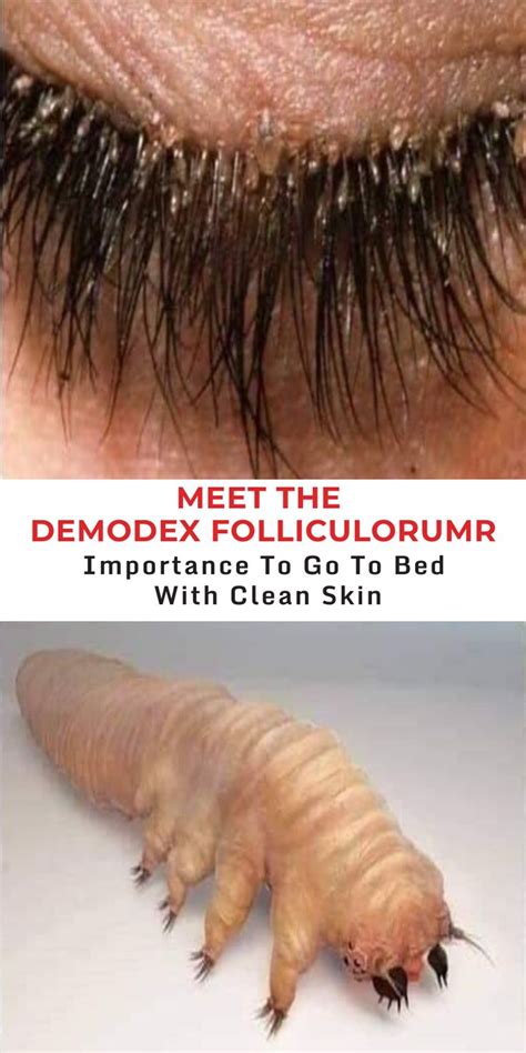 Hello My Name Is Demodex Folliculorum And I Live In The Pores Of The