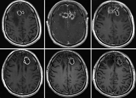 Serial Mri T1 Sequence With Contrast Showing The Disease Course Over
