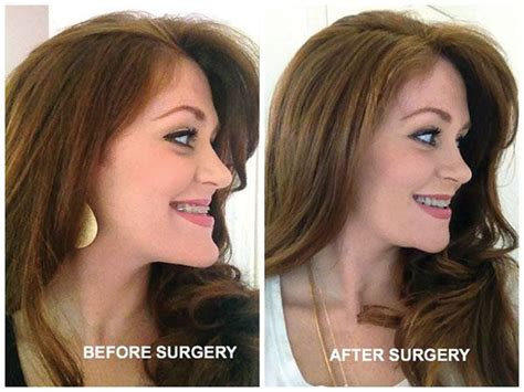 The First Phase Was A Procedure To Widen Her Upper Jaw And Further