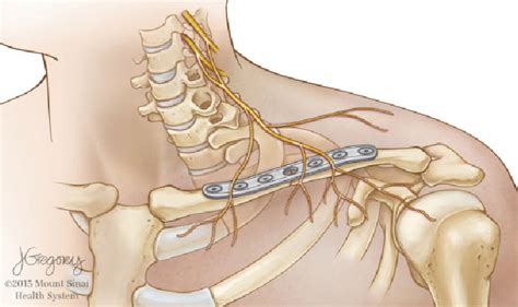 Supraclavicular Nerve Model