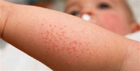 Dermatite Atopica Nei Bambini Sintomi E Cure Mammeoggi It Sexiz Pix