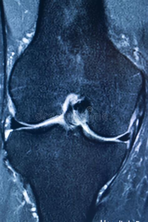 Knee Injury Mri Mcl Tear Stock Image Image Of Resonance 154117387