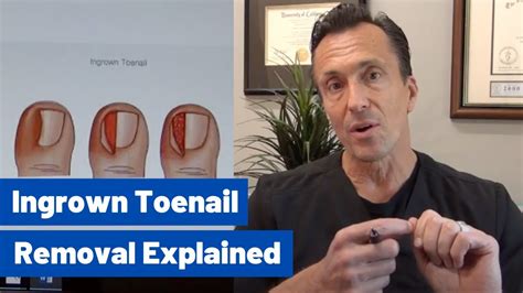 Ingrown Toenail Removal Dr Moore Explains The Permanent Cosmetic