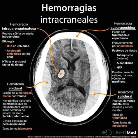 Hemorragias Intracraneales Medical Anatomy Radiology Student Radiology