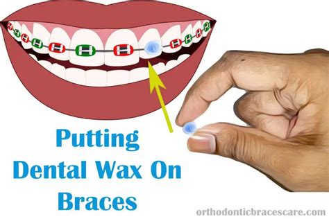 How To Apply Dental Wax On Braces Step By Step Guide Orthodontic