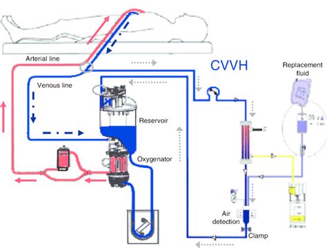 Continuous Venovenous Hemofiltration Cvvh While Connected To The