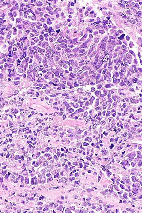 Small Cell Carcinoma Of The Prostate Gland Libre Pathology