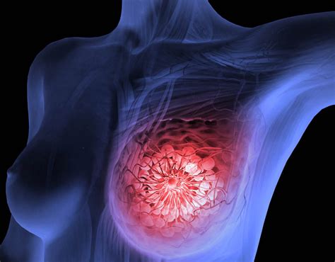 About 1 out of every 100 breast cancers diagnosed in the united states is found in a man. Breast cancer: New test could spare thousands from ...