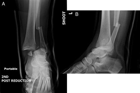 Irreducible Ankle Fracture Dislocation Due To Tibialis Anterior