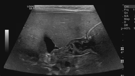 Pyloric Ultrasound Sonographic Tendencies