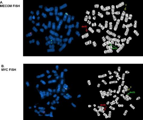 Deciphering The Complexities Of Mecom Rearrangement Driven Chromosomal