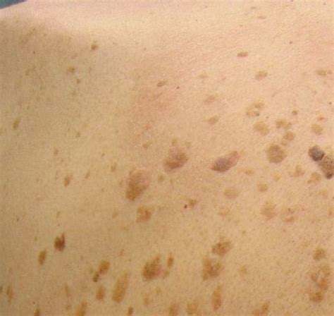 Quick Facts About Seborrheic Keratosis Hot Sex Picture