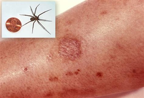 Medically Significant Spider Bites Which To Watch Out For