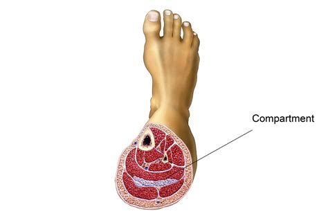 Chronic Exertional Compartment Syndrome Cecs Mobile Physio