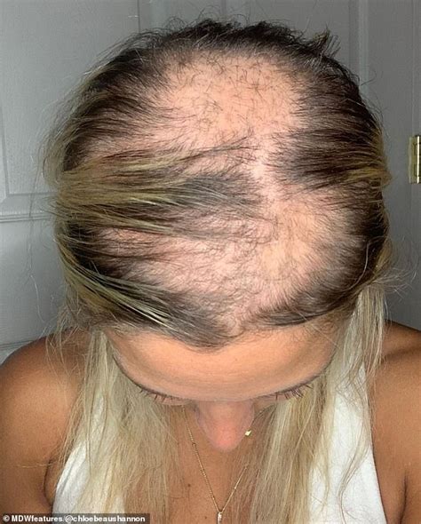 Woman Reveals Shaving Her Head Helped To Overcome Insecurities Daily