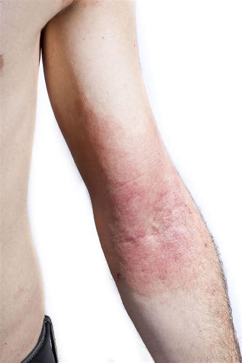 Skin Rash Caused By Dilantin May Actually Be Stevens Johnson Syndrome