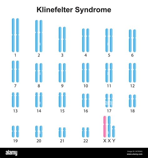 Cariotipo Del Sindrome De Klinefelter Im Genes Recortadas De Stock