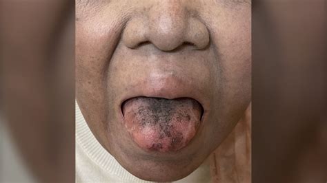 Black Hairy Tongue Developed After Cancer Treatment Primenewsprint