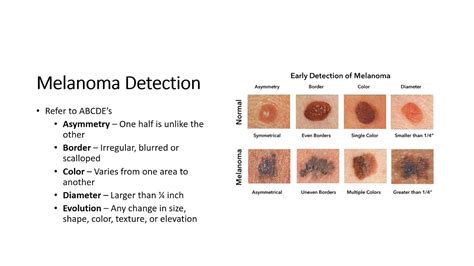 Abcde Rule Of Skin Cancer Detection