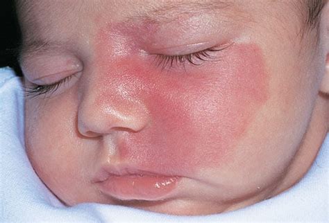 Maybe you would like to learn more about one of these? Birthmarks Slideshow: Pictures of Port Wine Stains, Moles ...