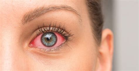 ojo seco causas síntomas tratamientos y su relación con el glaucoma lookvision