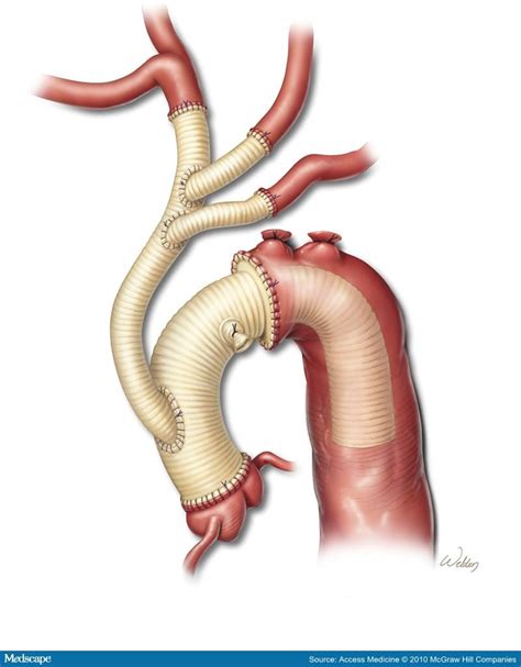 Aortic Dissections And Thoracic Aneurysms An Update