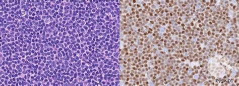 mantle cell lymphoma