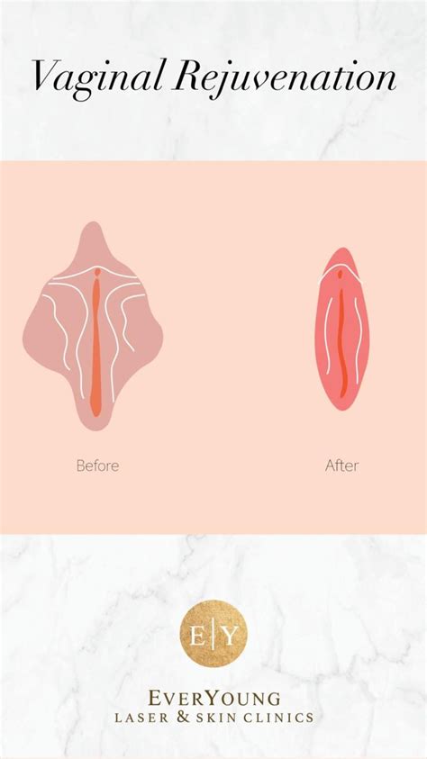 Vaginal Rejuvenation Skin Care Anti Aging Before And After Healthy Skin O Shot In