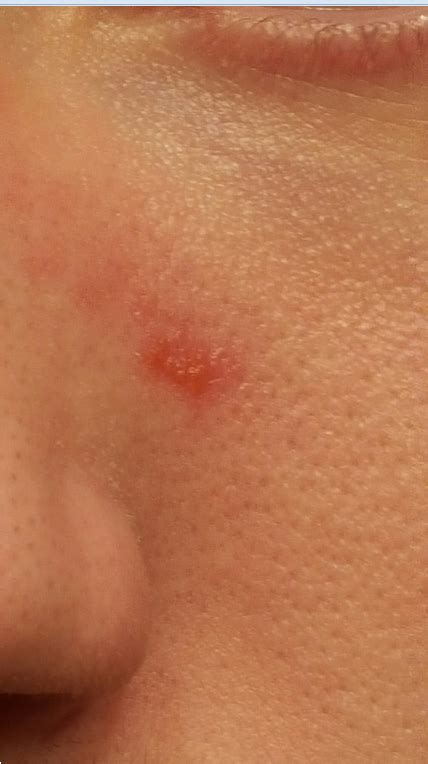 Skin Concern Red Spot Appearing On Same Area Of Face Details In