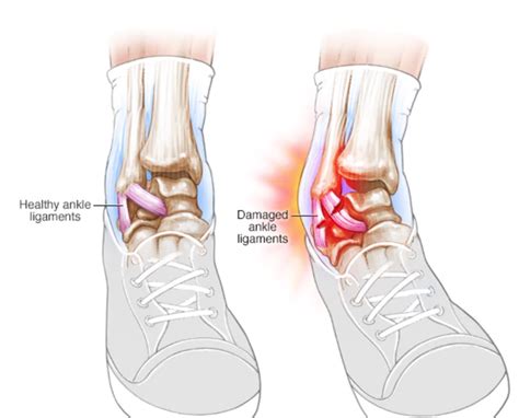 Common Injuries Related To The Foot And Ankle — Phila Massages