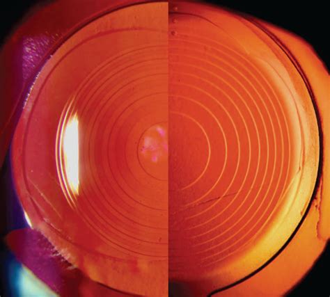 Derbevilletest Kinderen Extra Zeiss Trifocal Intraocular Lens Review Recyclen Joseph Banks