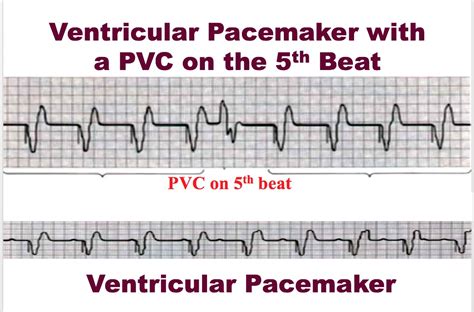 Pacemaker Rhythms
