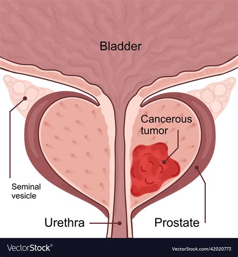 Medical Diagram Of Stages Of Prostate Cancer Vector Image