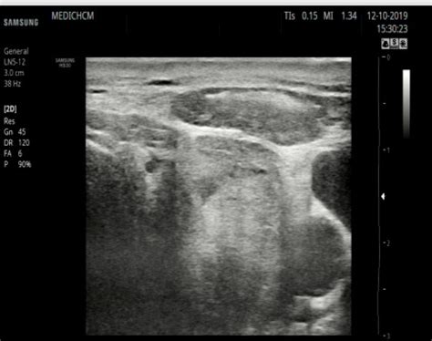 Vietnamese Medic Ultrasound Case Subacute Thyroiditis De Quervain